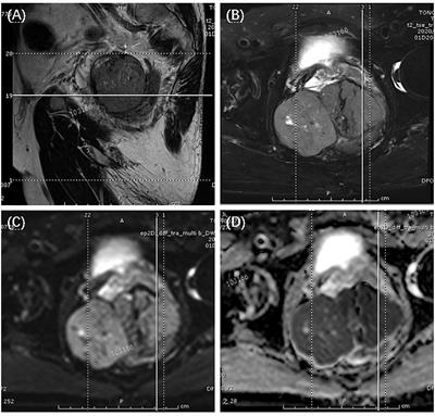 Primary extragastrointestinal stromal tumors of the prostate: A case report and literature review